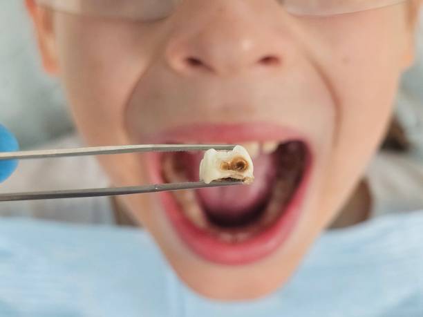 Best Chipped Tooth Repair Near Me  in Tn Lakes, WI